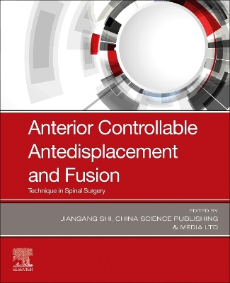 Anterior Controllable Antedisplacement and Fusion (ACAF): Technique in Spinal Surgery
