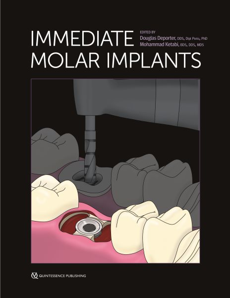 Immediate Molar Implants 1