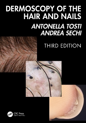 Dermoscopy of the Hair and Nails 3e 3rd edition