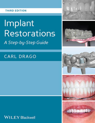 Implant Restorations: A StepbyStep Guide 3rd Edition