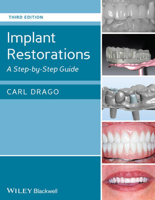 Implant Restorations: A Step-by-Step Guide