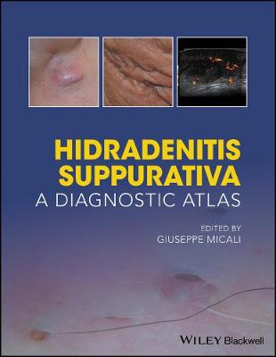 Hidradenitis Suppurativa: A Diagnostic Atlas