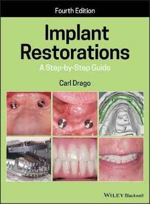 Implant Restorations  A StepbyStep Guide