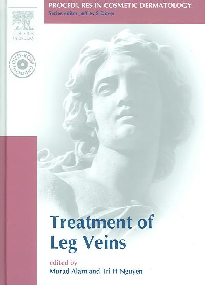 Treatment of Leg Veins