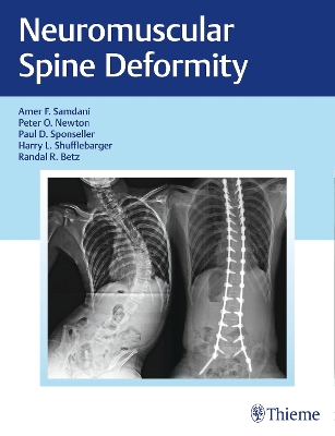 Neuromuscular Spine Deformity New edition