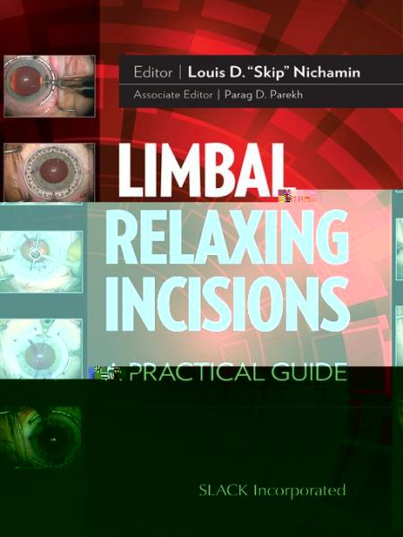 Limbal Relaxing Incisions: A Practical Guide