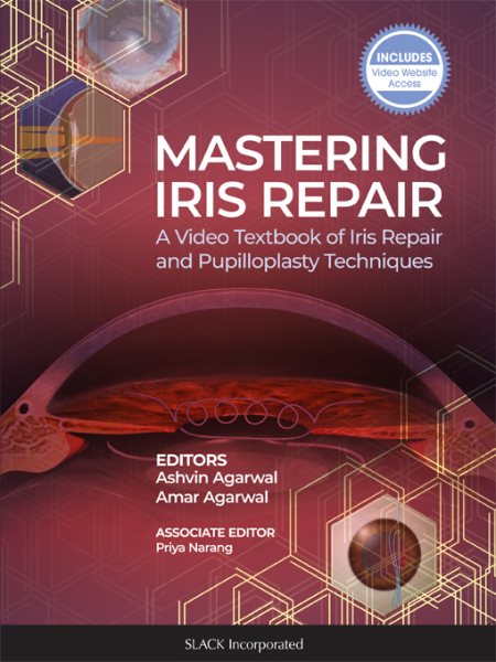 Mastering Iris Repair: A Video Textbook of Iris Repair and Pupilloplasty Techniques