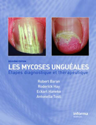 Onychomycosis/Les Mycoses Ungueales: Etapes Diagnostique Et Clinique