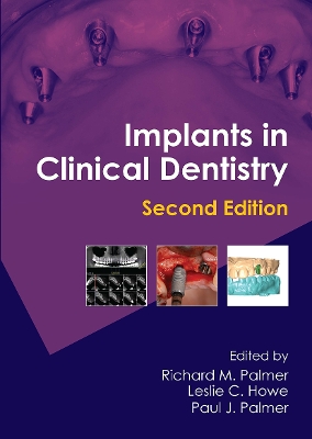 Implants in Clinical Dentistry 2nd edition