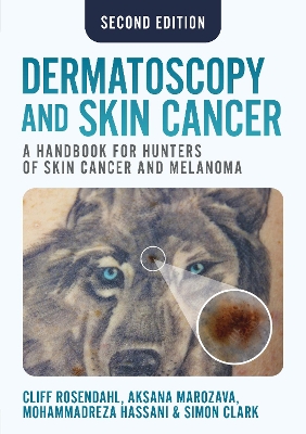 Dermatoscopy and Skin Cancer, second edition: A handbook for hunters of skin cancer and melanoma