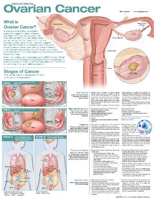 Understanding Ovarian Cancer Anatomical Chart 2nd edition