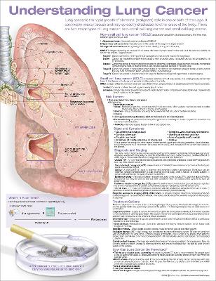Understanding Lung Cancer Anatomical Chart 2nd edition