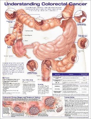 Understanding Colorectal  Cancer Anatomical Chart 2nd edition