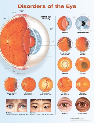 Disorders of the Eye Anatomical Chart 3rd edition