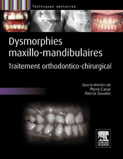 Dysmorphies maxillo-mandibulaires: Traitement orthodontico-chirurgical