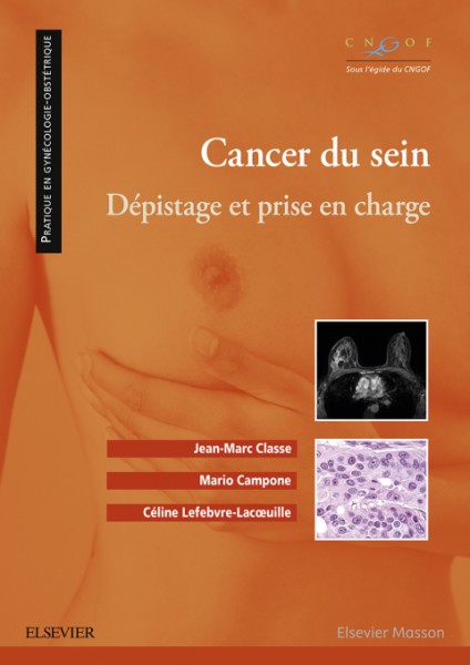 Cancer du sein: Depistage et prise en charge
