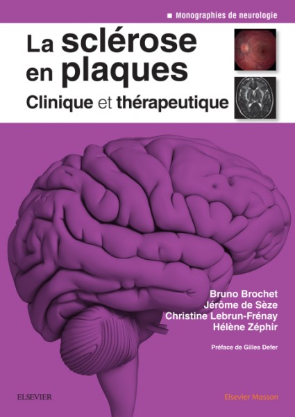 La sclÃ©rose en plaques - Clinique et thÃ©rapeutique