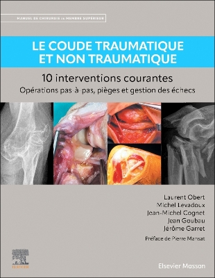 Le coude traumatique et non traumatique - 10 interventions courantes: Manuel de chirurgie du membre superieur