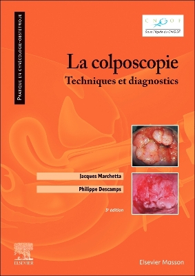 La colposcopie: Techniques et diagnostics