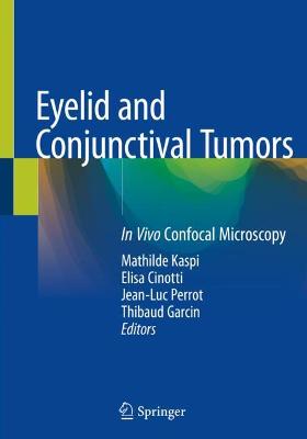 Eyelid and Conjunctival Tumors: In Vivo Confocal Microscopy 2020 ed.