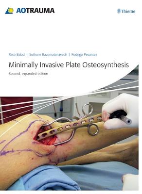 Minimally Invasive Plate Ostheosynthesis Second, expanded edition