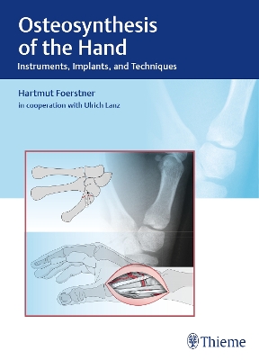 Osteosynthesis of the Hand: Instruments, Implants, and Techniques New edition