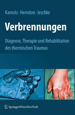 Verbrennungen: Diagnose, Therapie und Rehabilitation des thermischen Traumas
