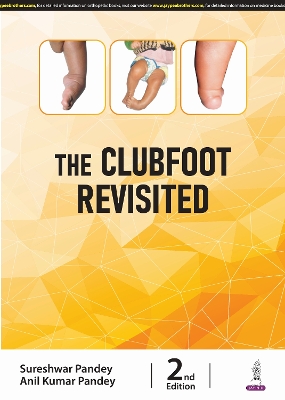 Clubfoot Revisited 2nd Revised edition