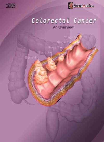 Colorectal Cancer: An Overview