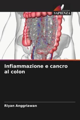 Infiammazione e cancro al colon