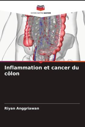 Inflammation et cancer du côlon